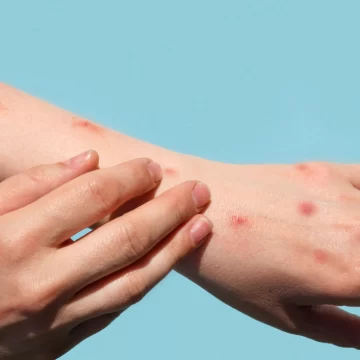 എംപോക്‌സ് സ്ഥിരീകരിച്ചു